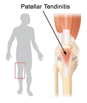 Patellar tendinitis - Zeh Chiropractic